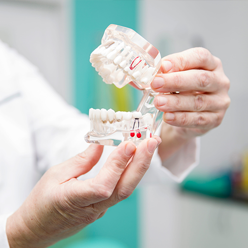 Dental implant model in hands